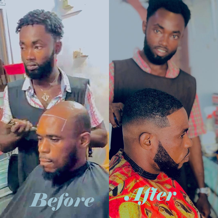 /Artificial hair replacement